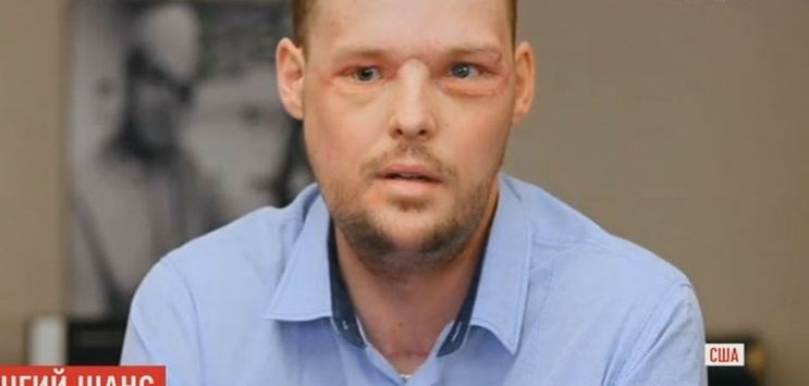 Хірурги в США дві доби пересаджували чоловікові нове обличчя