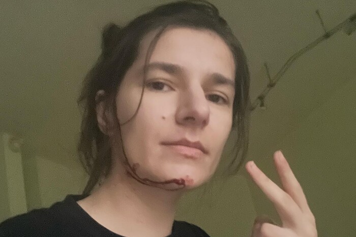 Скло порізало обличчя: під час удару РФ по Харкову була поранена волонтерка Попова (фото)