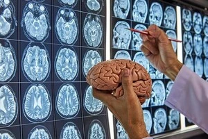 Вчені досліджували деградацію мозку