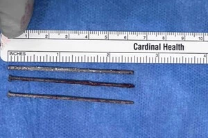 Американець місяць проходив із цвяхами в животі після поранення