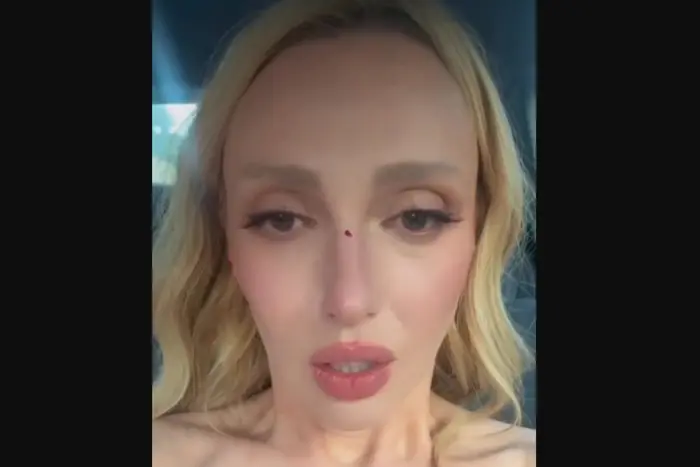 Полякова потрапила в аварію та показала розбитий ніс (відео)