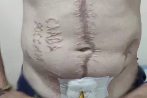 Випалений напис «Слава Росії» на тілі захисника. Україна підтвердила справжність фото