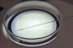 У пацієнтки діагностували підшкірний дирофіляріоз