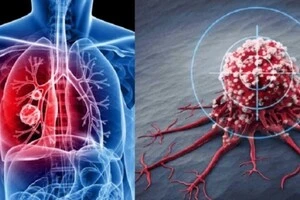 Рак більше не є смертним вироком – Times 