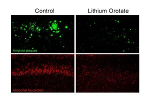 Хвороба Альцгеймера сьогодні вражає понад 55 млн людей у світі