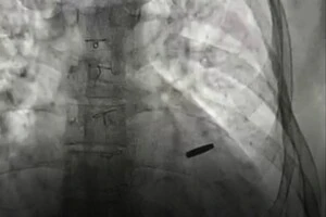 Лікарі Інституту серця успішно видалили кулю з серця захисника Маріуполя після трьох років у полоні