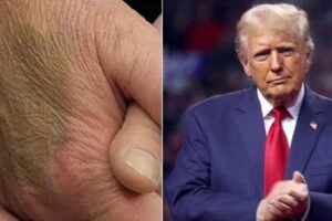 ЗМІ не один раз фіксували синці на руці Трампа