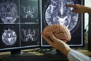 Австралійсько-американські вчені розробили ультразвук для виведення токсинів з мозку після ішемічного інсульту