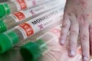 Мавпяча віспа мутувала: Європа потерпає від нового штаму, стійкого до ліків
