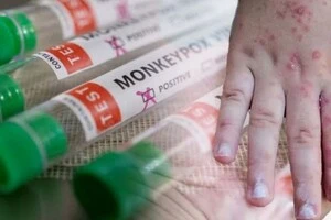 Мавпяча віспа мутувала: Європа потерпає від нового штаму, стійкого до ліків