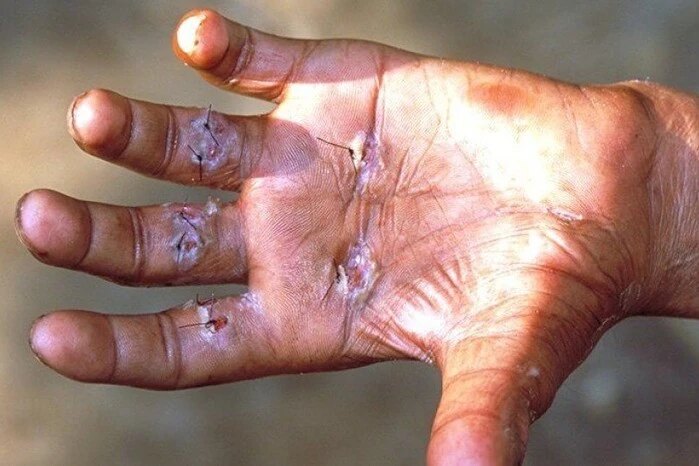 У сусідній з Україною країні вперше за 40 років зафіксовано випадки небезпечної хвороби