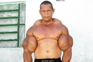 бодибілдер Арліндо де Соуза з Бразилії робив собі небезпечні ін'єкції в руки