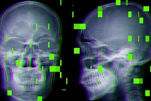 Пацієнти звернулися до суду з позовами проти розробника медичного інструмента, що використовує штучний інтелект