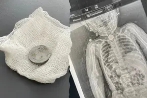 У стравоході дитини застрягла літієва батарейка діаметром 2,5 см