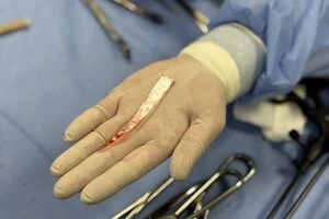 Лікарі зуміли витягти величезне скло з легені пацієнта