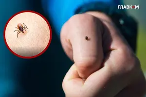 Лікарі не радять займатися самолікуванням після укусу чи виявлення кліща на шкірі