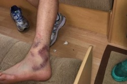  Травма Тайсона Ф’юрі 