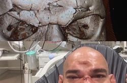 Бійцю ММА під час поєдинку коліном проломили череп