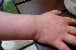 Найбільший ризик захворіти - у малюків від 2 до 5 років