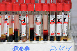 Борець зі СНІДом закликав обстежити всіх росіян на ВІЛ: у країні шалена епідемія