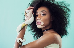 Модель с заболеванием кожи стала лицом рекламной кампании Nike