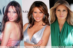 Melania Makeover: сколько стоят пластические операции первой леди США