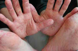 Вірус Коксакі  проявляється порушенням роботи кишечника, діареєю, загальною інтоксикацією і характерною висипкою 