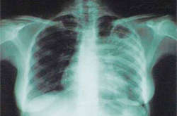 Бойовиків на Донбасі «косить» туберкульоз