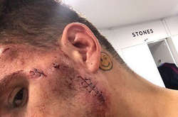 Обличчя Едерсона після зіткнення