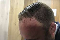 Волосы обгорели: появились шокирующие фото пострадавшего из лондонского метро