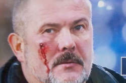 Побитий на футболі нардеп написав заяву до поліції та зняв побої