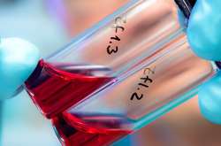 Зупинити СНІД: Україні радять повчитися в німців