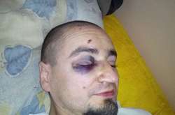 Поет Артем Полежака випав із другого поверху: його доправили до лікарні