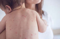 Найбільше хворіють на кір діти