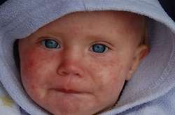 Протягом 2018 року у Києві вже госпіталізували 16 хворих на кір дітей