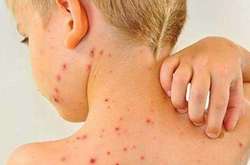 У Києві епідемія кору: з початку року захворіли 43 дитини