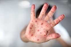 Спалах кору: у групі ризику нещеплені діти та діти до п’яти років