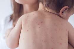 Хвора на кір дитина