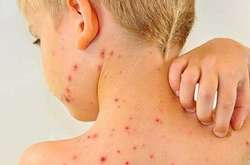  Станом на ранок понеділка, 15 січня, з початку 2018 року у Києві зафіксовано 87     випадків кору 