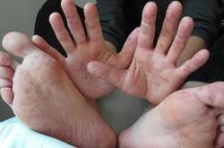 У Херсоні до лікарень забрали п’ятьох людей з підозрою на кір 