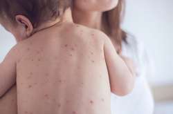 У Києві на кір захворіло вже майже 100 людей 