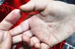 В Україні від кору померла ще одна дитина 