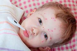 Найбільше на кір хворіють діти