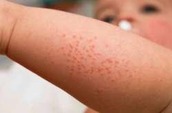 На Кіровоградщині зафіксували шість випадків кору 