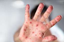  Не было зафиксировано ни одного случая заболевания корью только в Черниговской области 