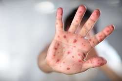 Дівчинка померла від кору на Закарпатті