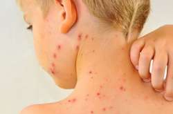 В Одесу доставлять ще тисячу доз вакцини від кору