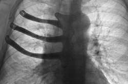 Британські лікарі надрукували пацієнтові грудну клітку на 3D-принтері