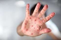 Україна посіла третє місце у Європі за кількістю хворих на кір