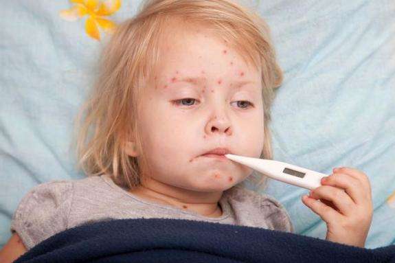 За два місяці в Україні на кір захворіли більше п’яти тисяч людей